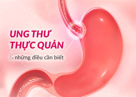 ung thu thuc quan la gi